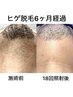 【ヒゲ卒業応援プログラム】痛みが少なく効果実感大！光脱毛3回コース¥14900 