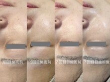 ヒュウ(hue.)/韓国発最新肌管理[セルマン]