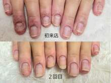 深爪矯正 爪悩み専門店 グラシナ 西宮北口店【4/3 NEW OPEN（予定）】/