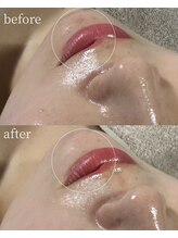 サロンナナジュウニ(Salon72)/ニキビ/肌荒れ