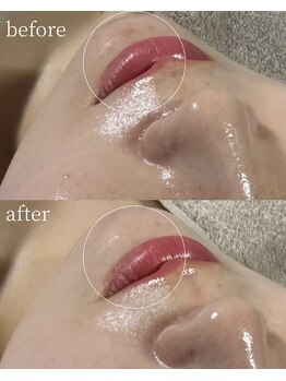 サロンナナジュウニ(Salon72)/ニキビ/肌荒れ