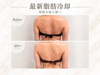 ポノピピ 小倉本店(ponopipi)の写真/ノースリーブも自信！脂肪冷却×リポベラで二の腕・ハミ肉を徹底ケア★口コミ4.9講師在籍サロン◎