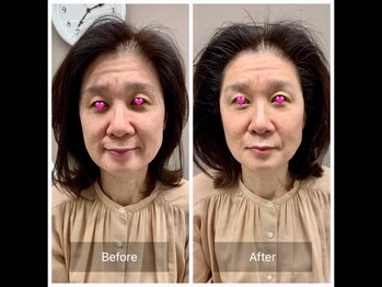 ミセルラボ 博多店(Misel Labo)/驚きの超音波トリートメント!