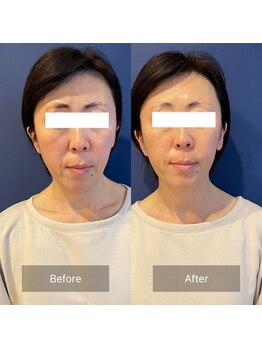 フフラ KANコルギセラピー山梨本店(fufla)/小顔ソムリエ【小顔　頭蓋骨】