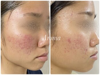 アロマ(AROMA)/赤ニキビケア/毛穴/越谷