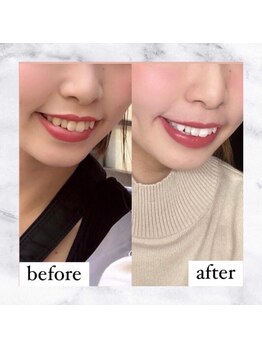 ライトケアサロン 表参道店(Light Care Salon)/ホワイトニング効果♪
