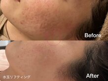 サロンヴェアリー 広尾(salon vary)/お肌管理は継続が大切#ldm#水玉