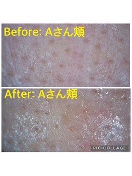 バルーサヤ 吉祥寺(Baru Saya)/Before-After Aさん頬（４０代）