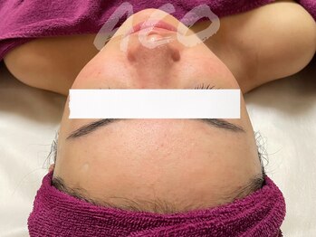 スキンケアスタジオ アコ 新宿店(Aco)/ニキビ/跡/肌荒れ/GP１Dを続けて