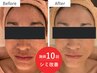 【美白・シミ改善】乳酸ピーリング＋脂肪&神経エクソソーム導入 通常18800円