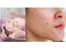 [毛穴皮脂詰まり除去+赤みニキビ改善フォト60分]70％off￥15000→￥4999