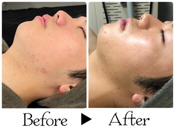 ルース(LUZ)/ニキビケア・思春期ニキビケア