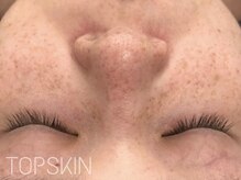 トップスキン 新宿(TOPSKIN)/30代のお客様／シミ・色素ケア