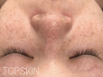 トップスキン 新宿(TOPSKIN)/30代のお客様/シミ・色素ケア