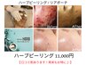 【ハーブピーリング】 ニキビケア◎　シミ・シワ改善◎ ¥11,000