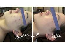 レイ(REI)の雰囲気（ニキビケアにはハーブピーリング+生活習慣の見直しを◆本厚木◆）