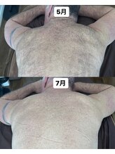 アカラ 読谷店(AKALA)/背中脱毛