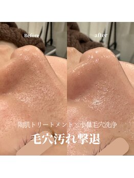 リモナ(Re-mona..)/REVIハーブピーリング×毛穴洗浄