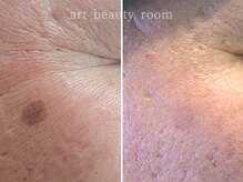 アート ビューティールーム(art beauty room)/☆OPL 光フェイシャル