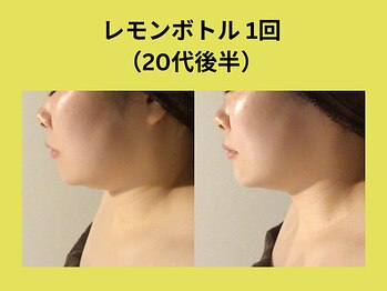 リンク 錦糸町店(Link)/レモンボトル1回