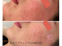 サロンヴェアリー 広尾(salon vary)/赤みや乾燥、ニキビに！#ldm