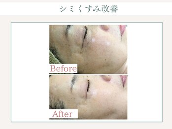 トータルビューティー ゆみえエステ(Total Beauty)/OHLハーブピーリング