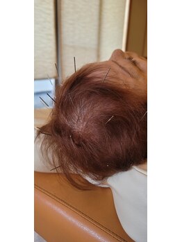 なかむら鍼灸院の写真/頭皮の血流を整え髪にハリ・コシをサポート。育毛促進鍼で抜け毛や髪のボリューム不足にアプローチ