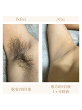 アルテ(ARTE)/脇脱毛ビフォーアフター