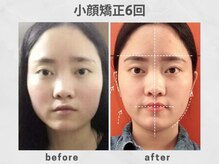 ビトリア 横浜店(BITORIA)/本格小顔矯正