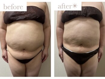 エバーグリーン(Evergreen)/脂肪冷却5回の変化