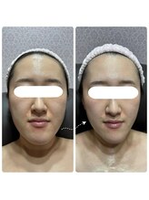 さりぃず ねぃる(SALLY’S NAIL)/すごい！光フェイシャルの効果♪