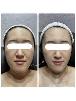 さりぃず ねぃる(SALLY’S NAIL)/すごい！光フェイシャルの効果♪