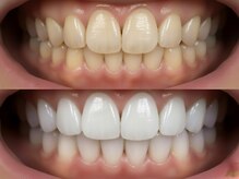 ダンブランシュサンダ(dents Blanches SANDA)/【ビフォーアフター】4回