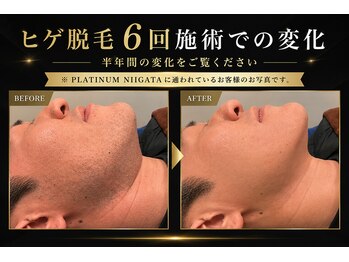 プラチナムニイガタ 新潟(PLATINUM NIIGATA)の写真/【完全個室☆】面倒なヒゲ剃りや清潔感を下げるムダ毛。全ての男性を悩ませる毛の悩みとおさらばしませんか