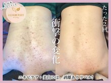 ハーバリー ハーブピーリング 大阪梅田店(HERBERRYハーブピーリング)/梅田ハーブピーリングHERBERRY