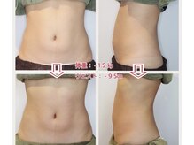 アクティブエイジング 金沢新竪町店/インディバボディ(お腹)