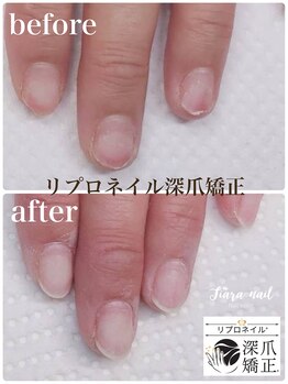 ティアラネイル 宇都宮/リプロネイル深爪矯正コース