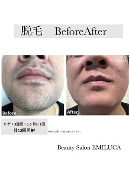 エミルカ(EMILUCA)/髭脱毛