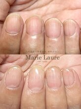 マリーロール 梅田店(Marie Laure)/自爪育成/深爪矯正/ネイルケア