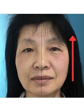 ネクスフィット(Nexfit)/小顔矯正フェイスリフトの効果