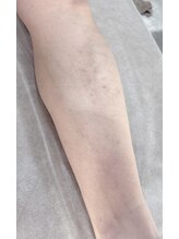 アンシュシュ(UNCHOUCHOU)/足脱毛３回目