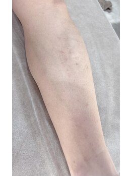 アンシュシュ(UNCHOUCHOU)/足脱毛3回目