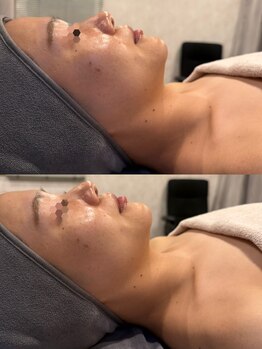 ブリア 横浜(BRILLA)/横顔美人になれます！