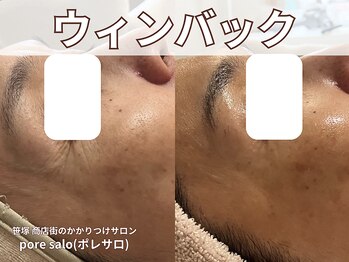 ポレ サロ(pore salo)/【ウィンバック｜たるみケア】