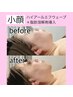 【小顔】ハイアール×溶解剤（脂肪）　効果はブログ、インスタみてね