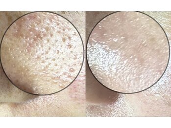 エムアンドエム(M&M)/鼻だけでなく頬の毛穴も綺麗！