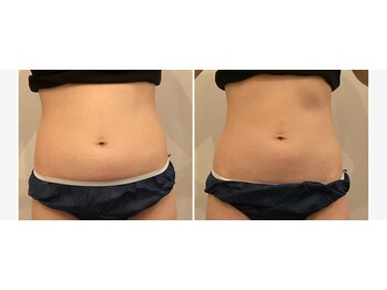 ギンザロッソ(GINZA ROSSO)/Before☆after