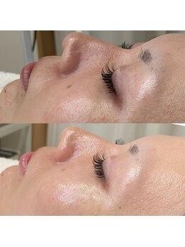 ブラン ネージュ(Blanc Neige)/レストセルトリートメント