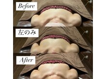 リノレア(LinoLea)/バストアップBefore after