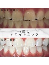 ホワイトスマイル(White Smile)/【ビフォーアフター】5回施術